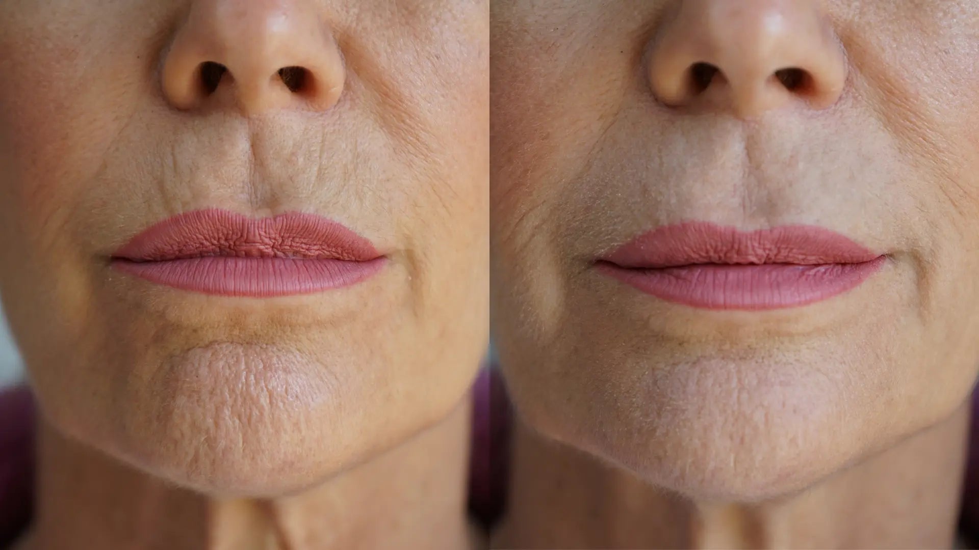 Ageless Lip & Line Filler – Anti-Aging Lip & Line Filler Treatment