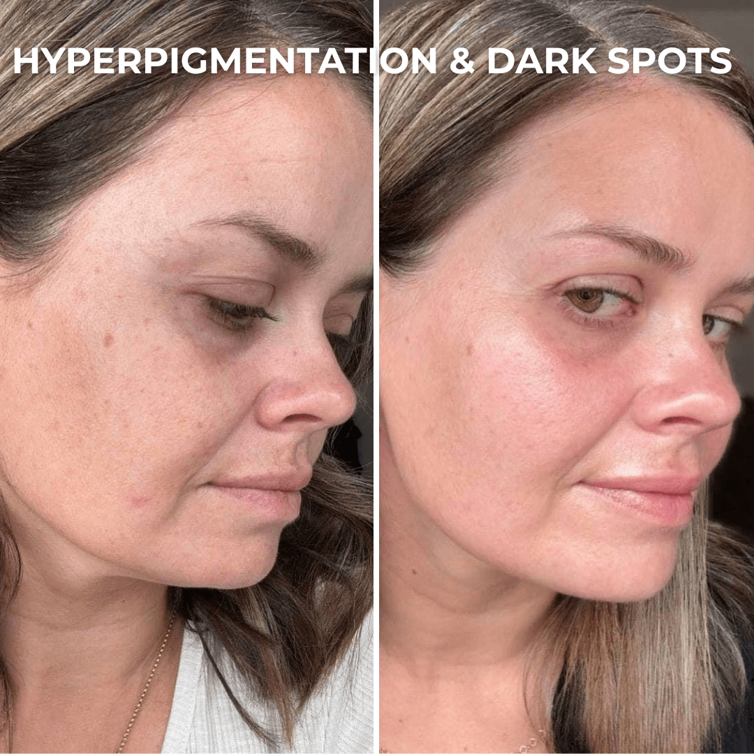 PDRN Collagen Peptide Hydrogel Mask - Sunnyside Beauty